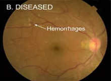 شناسایی بیماری چشمی مرتبط با دیابت توسط هوش مصنوعی گوگل